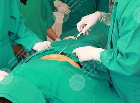 腰腹环吸多久消肿恢复