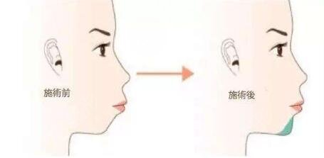 打玻尿酸垫下巴术后注意事项