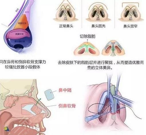 自体脂肪隆鼻