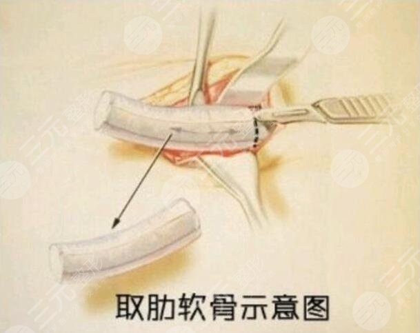 肋骨鼻和耳软骨哪个好