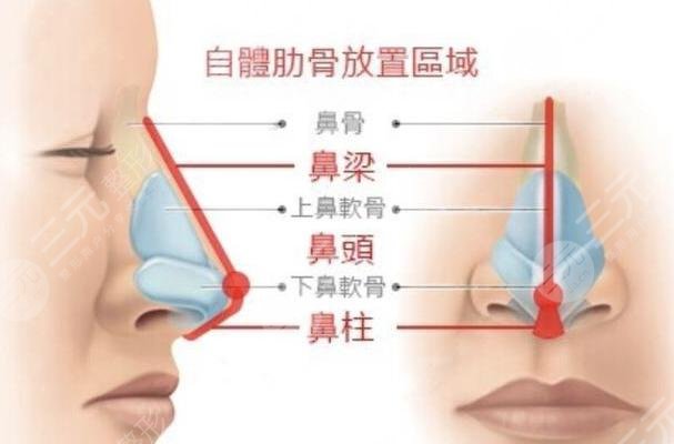 肋骨鼻和耳软骨鼻手术后注意事项