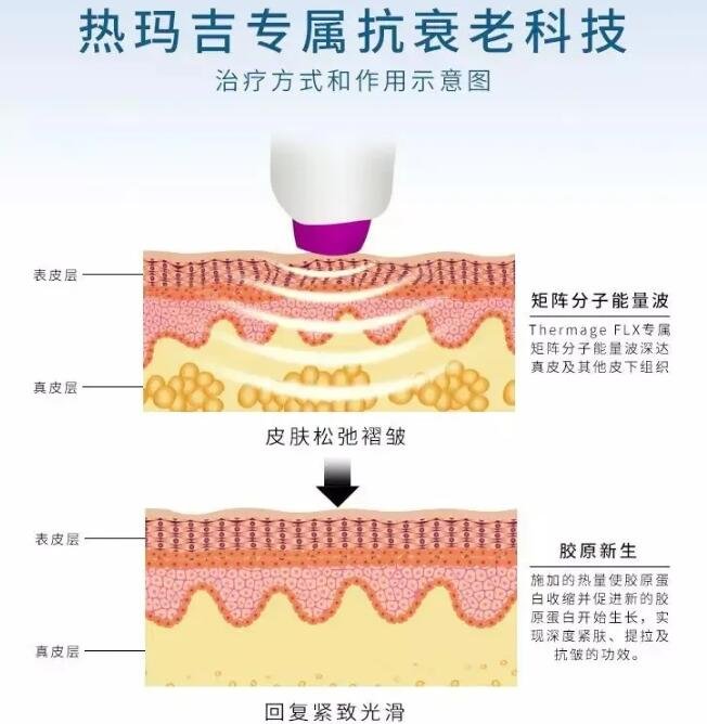 热玛吉新项目好坏