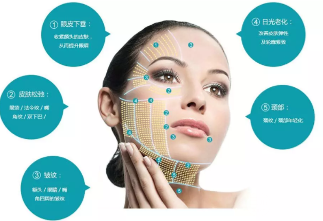热拉提可以去除皱纹吗