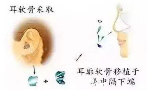 耳软骨垫鼻尖会被吸收吗