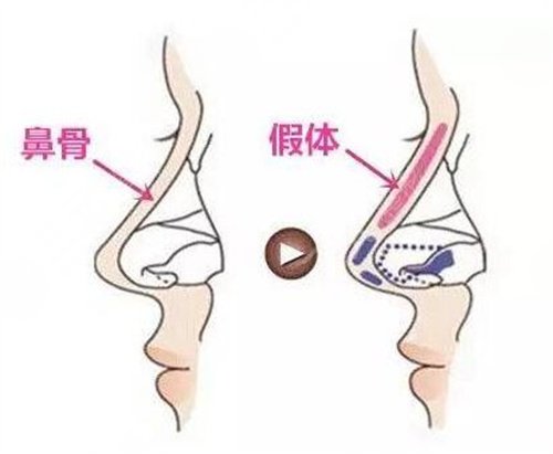 耳软骨垫鼻尖后5天