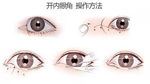 郑州大学第二附属医院整形外科割双眼皮后1个月