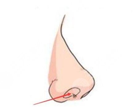 低鼻尖有哪些矫正方法