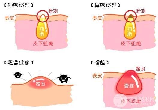 果酸焕肤