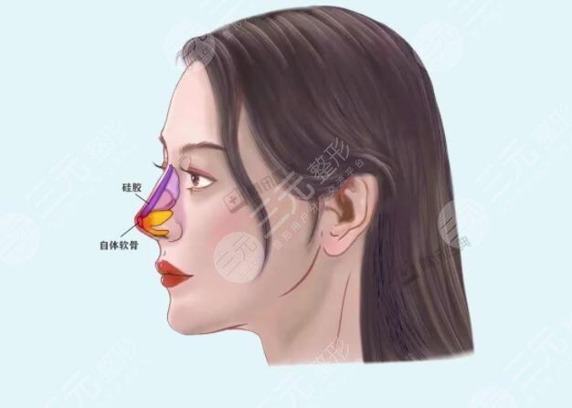耳软骨鼻子可以保持一辈子吗？专业人士告诉你正确答案[隆鼻知识]
