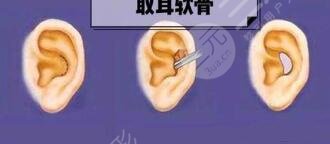 耳软骨鼻子可以保持一辈子吗