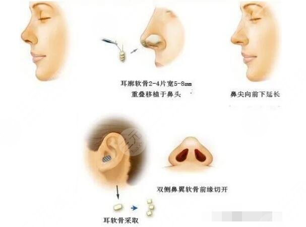 耳软骨鼻恢复需要多久