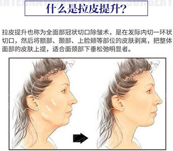 北京龙泽日盛医学抗衰中心科普拉皮手术