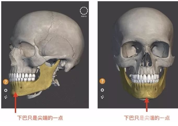 垫下巴还是做正畸