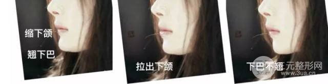 垫下巴还是做正畸