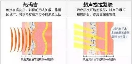 热拉提+热玛吉双项治疗