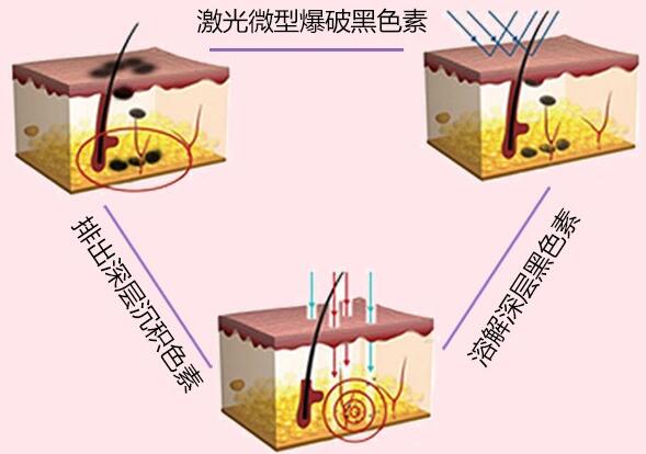 中国医学科学院皮肤病医院科普祛斑