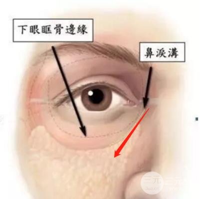 黄多多长大后泪沟黑眼圈全消？是做了整形吗？