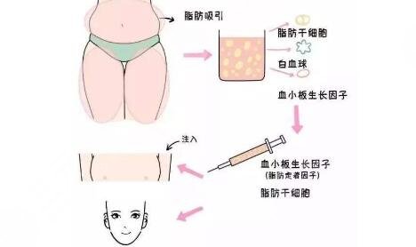 什么是详细部自体脂肪填充