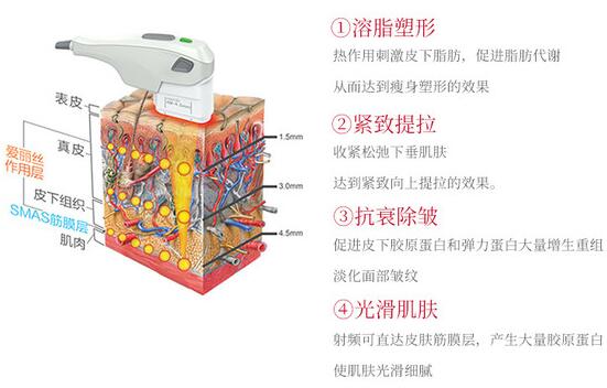 btl射频溶脂