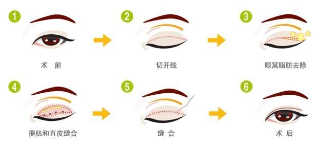 唐山润泽颜医疗整形医院科普双眼皮整形