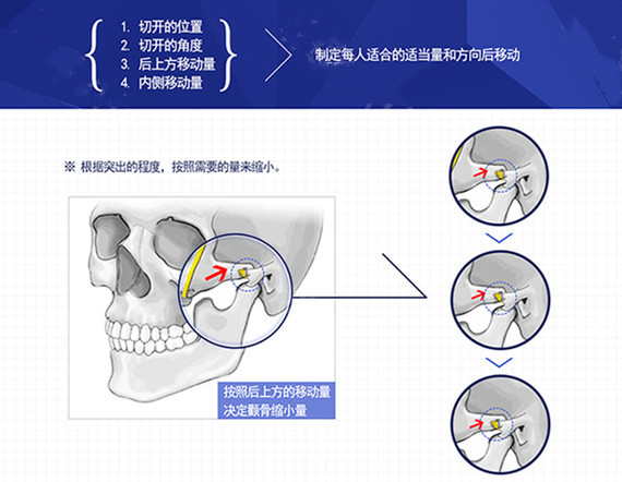 河南中医一附院赵绛波医生科普磨骨手术相关知识