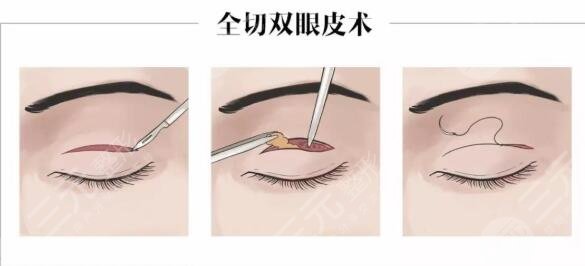 双眼皮手术是怎么样的呢?
