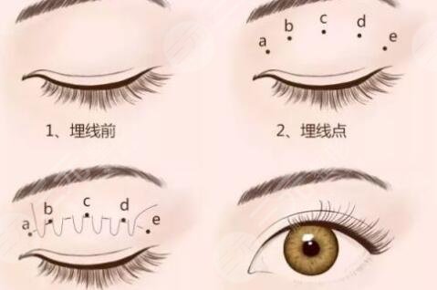 双眼皮手术的价格