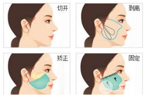 拉皮的副作用
