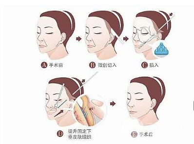 拉皮的副作用
