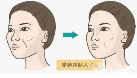 法令纹重！消灭法令纹的方法