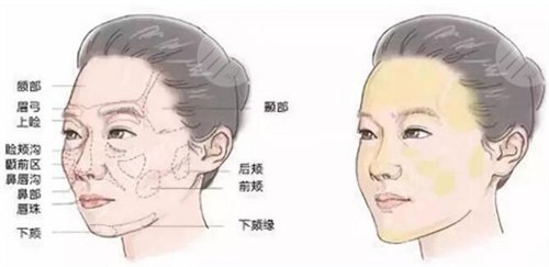 注射玻尿酸有什么副作用