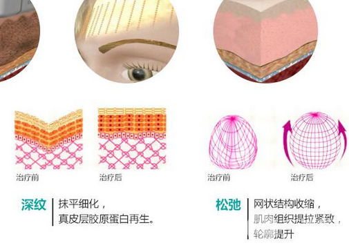 彩光嫩肤要多少钱