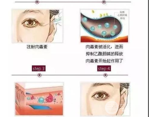 填充式注射除皱