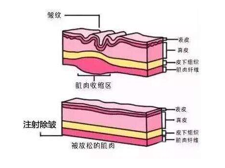 填充式注射除皱