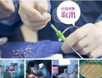 奥美定取出的方式