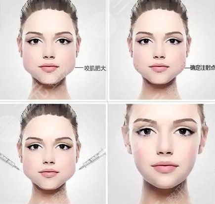 注射瘦脸多久打一次？小脸更上镜哦，转眼变身俏佳人