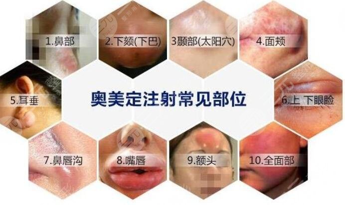 奥美定取出手术之后应该怎样护理