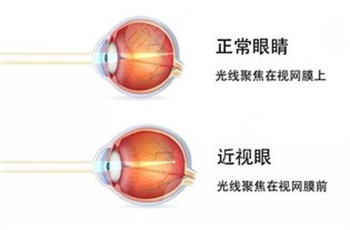 河南省人民医院眼科近视眼矫正手术