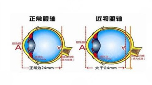 河南省人民医院眼科近视眼矫正手术