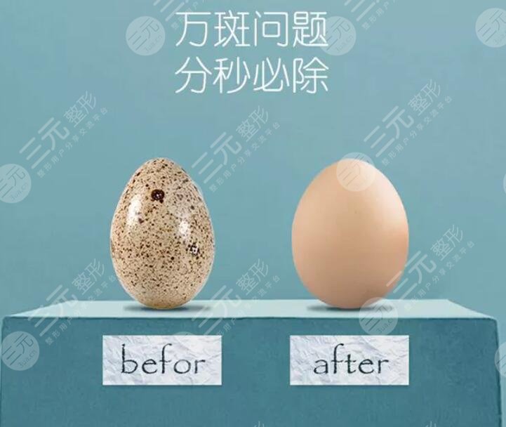 激光祛斑会反弹吗？该怎样一直保持着白净脸庞呢？