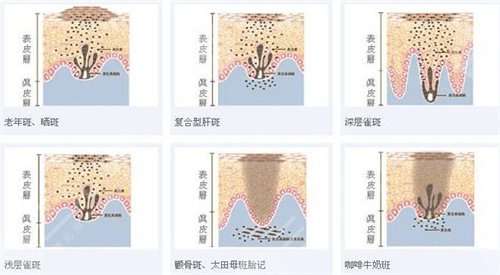 激光祛黄褐斑