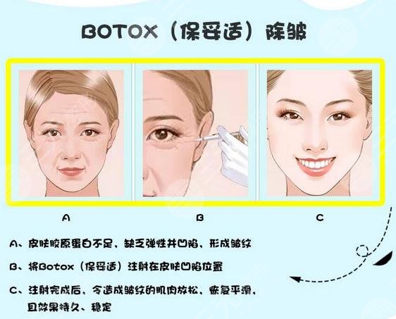 bot注射除皱成好吗