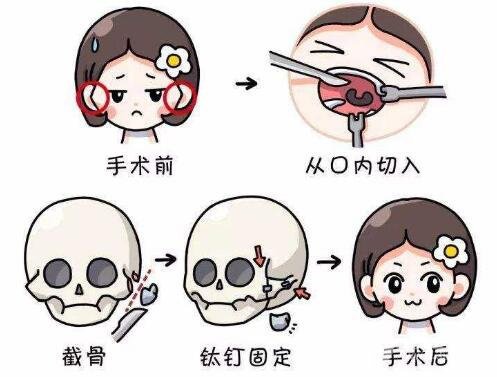 磨骨
