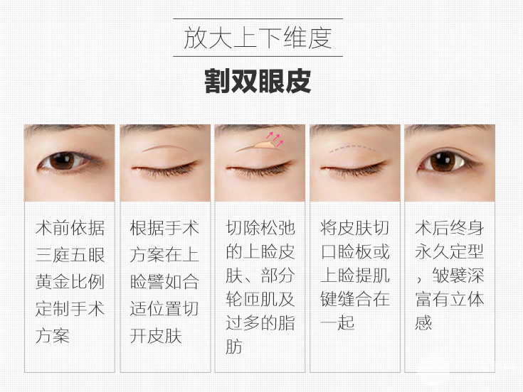 割双眼皮