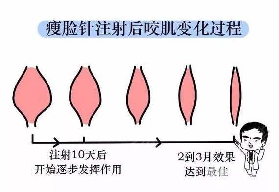 注射瘦脸