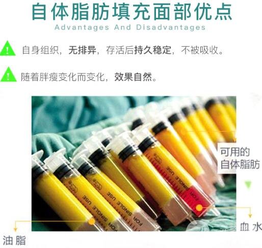 脂肪填充手术简介