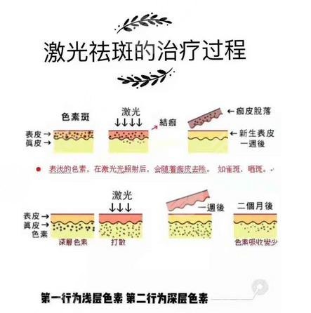 激光祛斑