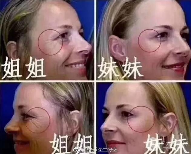 注射除皱
