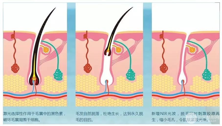 激光脱毛