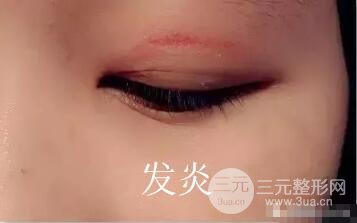 双眼皮贴发炎